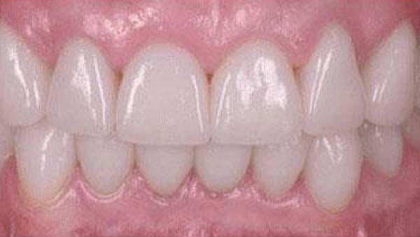 porcelain veneers patient 003 after