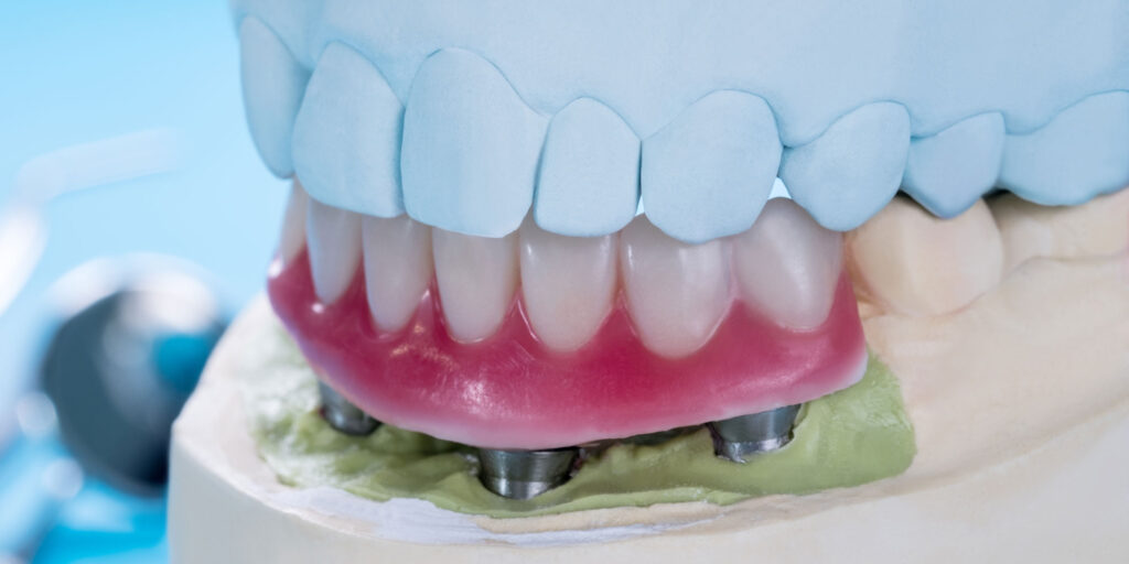 an implant supported denture model showing 3 of the 4 implants