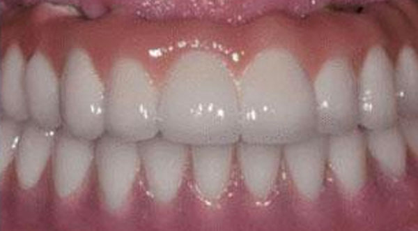 case-1-all-on-4-dental-implants-after