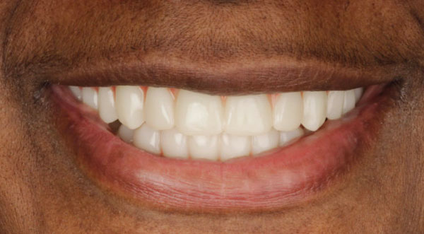 case-2-all-on-4-dental-implants-after