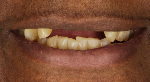 case-2-all-on-4-dental-implants-before