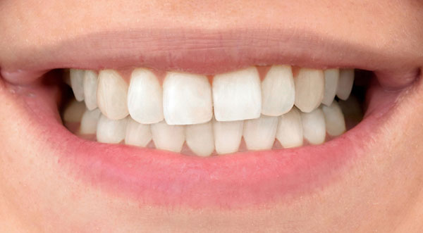 teeth-whitening-after