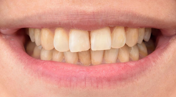 teeth-whitening-before